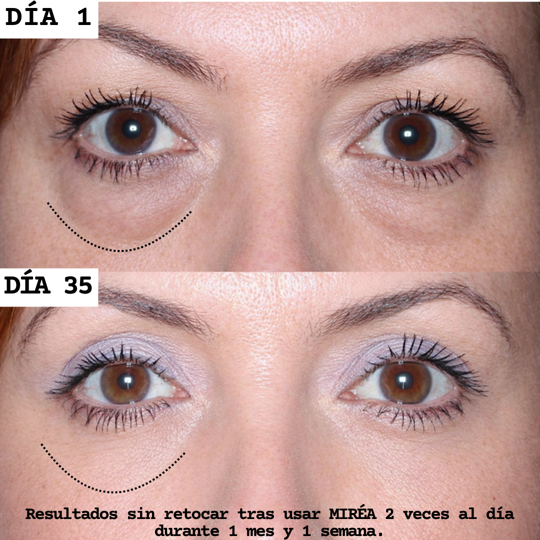 Adiós bolsas & ojeras. Más luz en tu mirada.